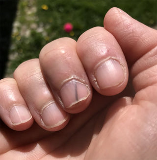 How to Get a Splinter out from under the Nail?