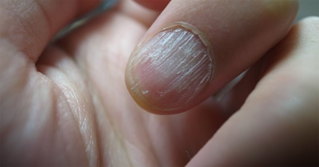 Three Ways How to Fix a Vertical Split Nail - DTK Nail Supply